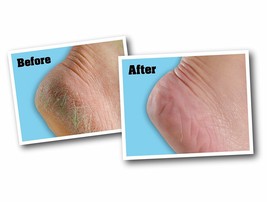 O&#39;Keeffe&#39;s Healthy Feet Foot Cream Formula Heals Relieves Repairs 3.2 oz... - £23.58 GBP