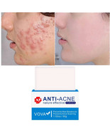 VOVA Anti-Acne Nature Effective Pure Skin - Acne Soap Bar for Breakouts ... - $14.92 CAD