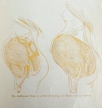 Impregnated Womb 8 &amp; 9 Months 1878 Victorian Medical Anatomy 1 Color Print DWV6B - £23.91 GBP