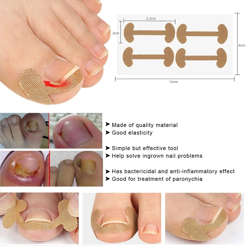 Sporting Ingrown Toenail Corrector Sticker Nail Strip Anti-roll Nail Free Glue T - £18.44 GBP