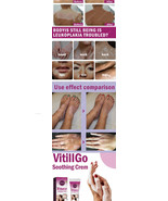 Vitiligo cream, effective elimination of vitiligo all over the body - $40.96 CAD