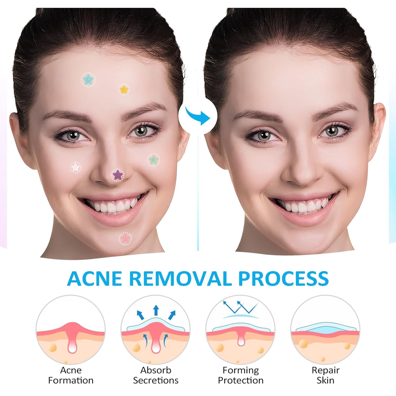 Pimple Patches for Face 240CT,3 Sizes Hydrocolloid Acne Patches,Cute Star Zit Pa Item image 4