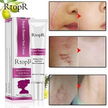 2PACK Acne Pimple Scar Acne Mark Spots Removal Treatment Gel Ointment Cream - $13.85