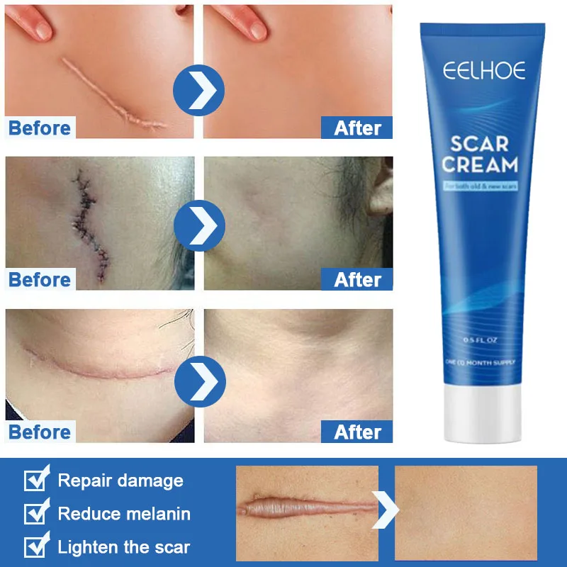 House Home Acne Scar Removal A Gel Skin Care Stretch Marks Remove Acne Spots Sur - £19.95 GBP