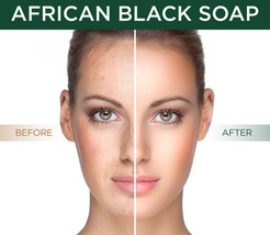 African Black Soap All Natural Best Acne Scar Blemish Blackhead Treatment Cure - £6.45 GBP