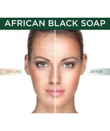 African Black Soap All Natural Best Acne Scar Blemish Blackhead Treatmen... - £6.34 GBP