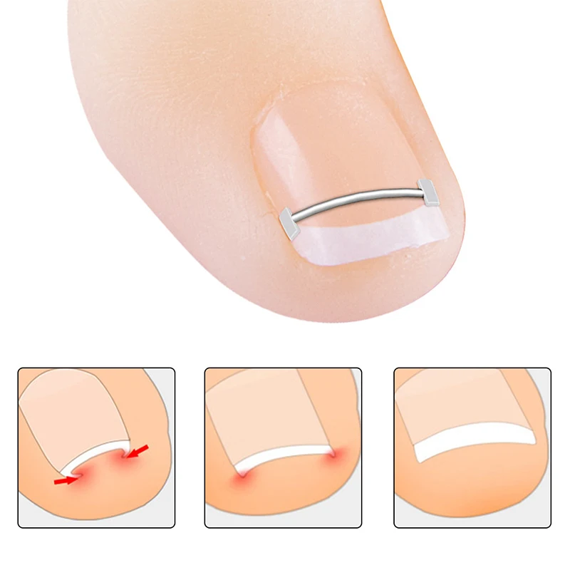 10pcs Ingrown Toenail Correction Clip Pedicure Tools Nail Treatment Elastic - £10.21 GBP