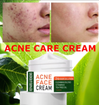 Acne Treatment Cream  Repair Acne  Shrink Pore Smooth Skin - $14.95