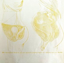 Impregnated Womb 3 &amp; 6 Months 1878 Victorian Medical Anatomy 1 Color Print DWV6B - £23.91 GBP