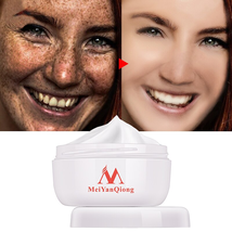 Facial Powerful Whitening Cream Remove Freckle Cream Acne Spots Cream - £11.86 GBP