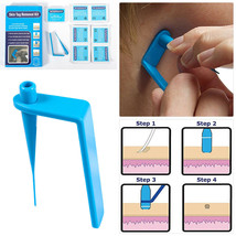 Micro Sets Skin Tag Remover Device Kit For Small To Medium Skin Tags Rem... - £11.72 GBP