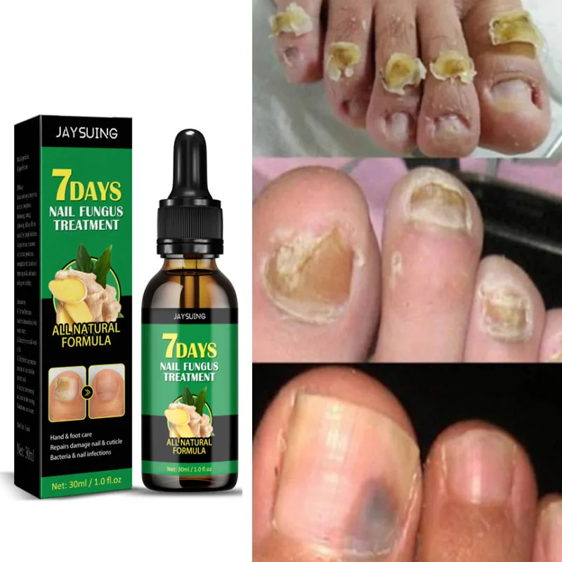 Sporting 7 Days Ginger Nail Fungal Treatment Feet Care Essence Anti Infection Pa - £28.86 GBP