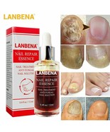 2 Pack Ginger Antibacterial Fungal Nail Treatment Nail Repair Oil Serum ... - $241.91 MXN