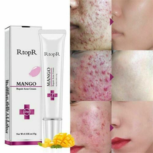 Primary image for 3 PK Rtopr Pimple Scar Acne Mark Spots Removal Treatment Gel Ointment Blemish