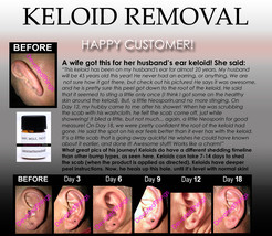 Ear keloid scar removal before and after pics copy thumb200