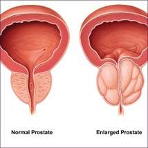 Prostate Care Reiki Energy System - £31.45 GBP