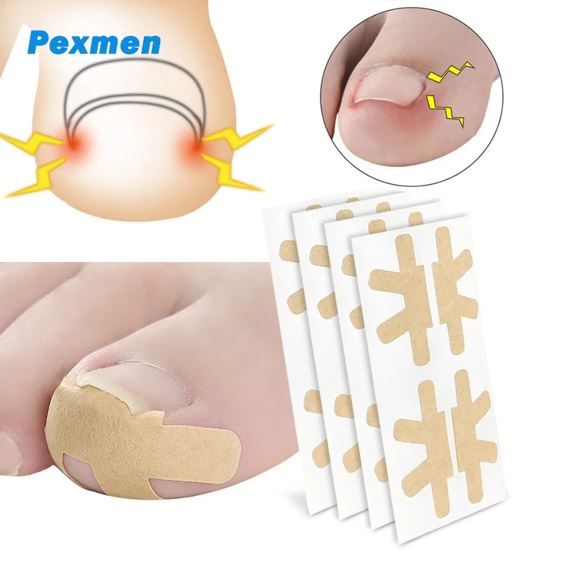 Pexmen 4/8/20Pcs Ingrown Toenail Correction Sticker Adhesive Toenail Patch - £7.33 GBP+