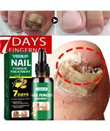 7 Days Fungal Nail Treatment Serum Fungus Removal Repair Gel Nails Care - $20.00+