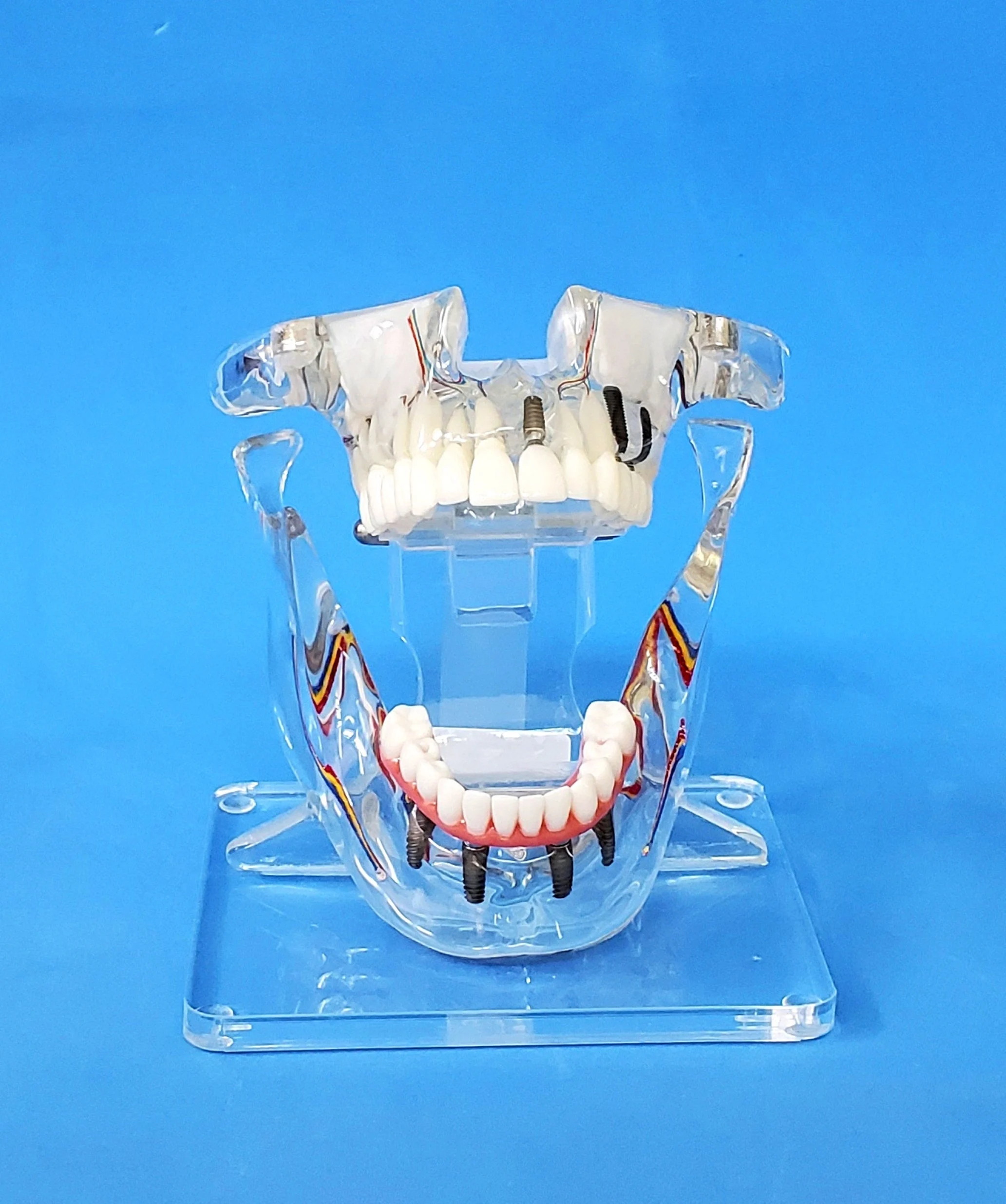 Sinuses Lift 7 Implants 2 Bridges Dental Combo Restoration Model  - £628.29 GBP