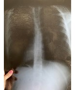 Real Lungs X-Ray Film Sheet Silver Spots Education Art 14x17 Inches PII ... - £56.32 GBP