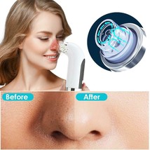 Blackhead Remover Pore Cleaner Vacuum Suction Acne Remover Pimple Black Dot Remo - £14.36 GBP+