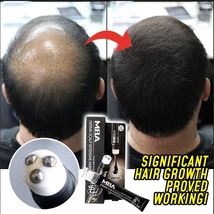 Bald Thining Scalp Intense Hair Growth Serum Triple Massager Fast Regrow Balding - £10.35 GBP