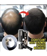 Bald Thining Scalp Intense Hair Growth Serum Triple Massager Fast Regrow... - $18.75 CAD