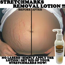 Fade Away Stretch Marks Treatment For Pregnancy Scars &amp; Keloids - £16.86 GBP