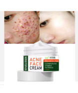 Acne Cream for Pimples Acne Spots Blackhead 30g - $6.99