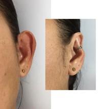 Big ears corrector - $53.00