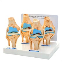 KNEE JOINT ARTHRITIS MODEL | 4 Stage Osteoarthritis | For Demonstration ... - £116.76 GBP