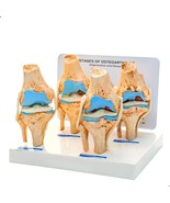 KNEE JOINT ARTHRITIS MODEL | 4 Stage Osteoarthritis | For Demonstration ... - £116.09 GBP