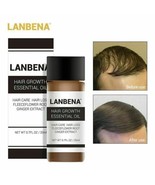 Unisex Lanbena Hair Loss Treatment Ginger Extract Hair Growth Essential ... - £6.46 GBP